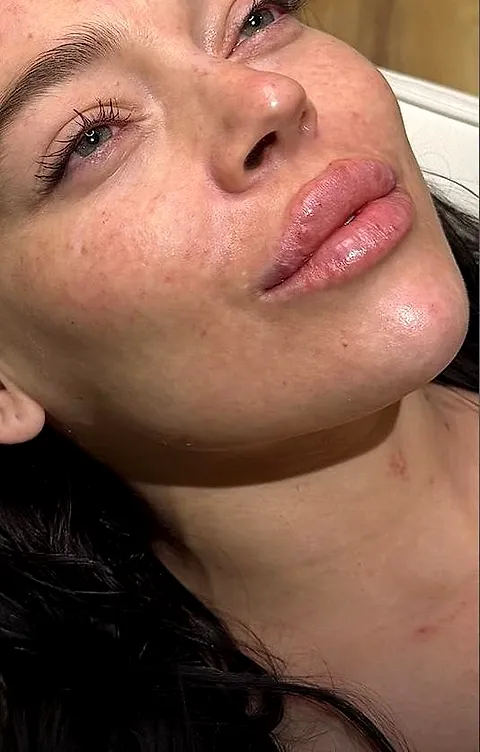 Full facial harmonisation, after
