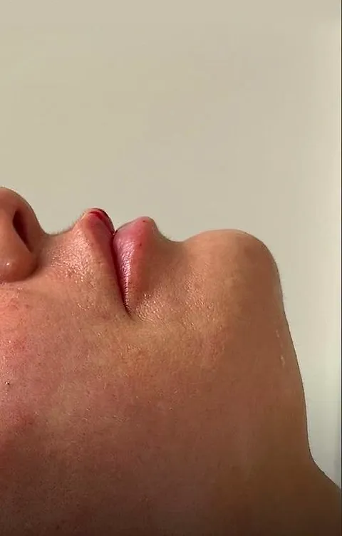 Chin dermal filler, after