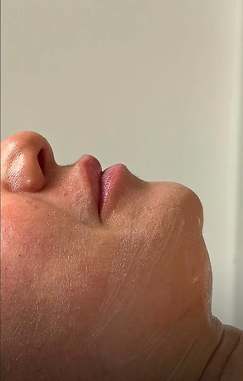 Chin dermal filler, before