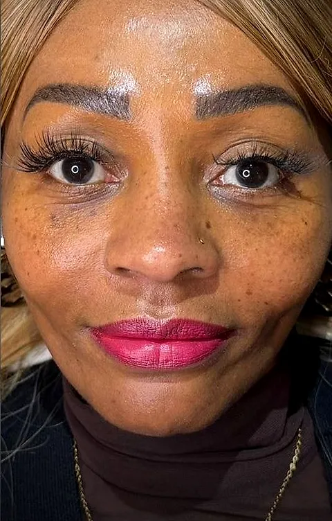 Tear trough filler, before