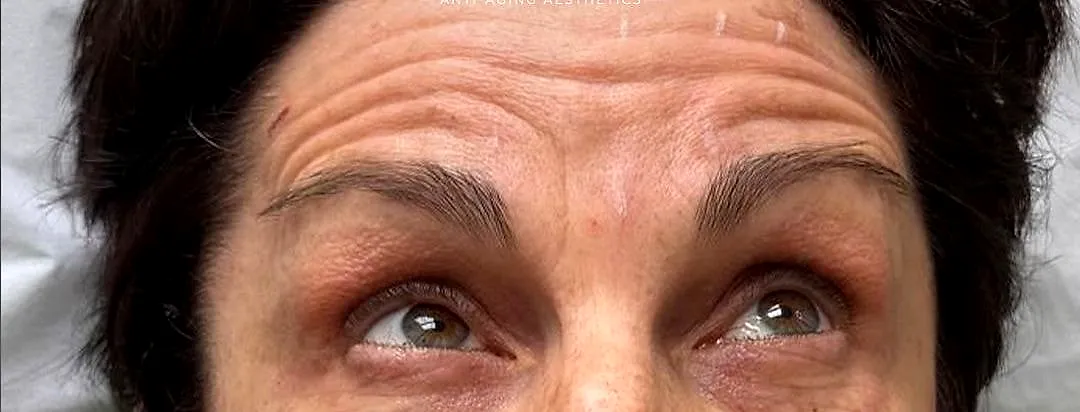 Anti-wrinkle, before