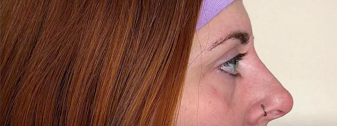 Liquid rhinoplasty, after