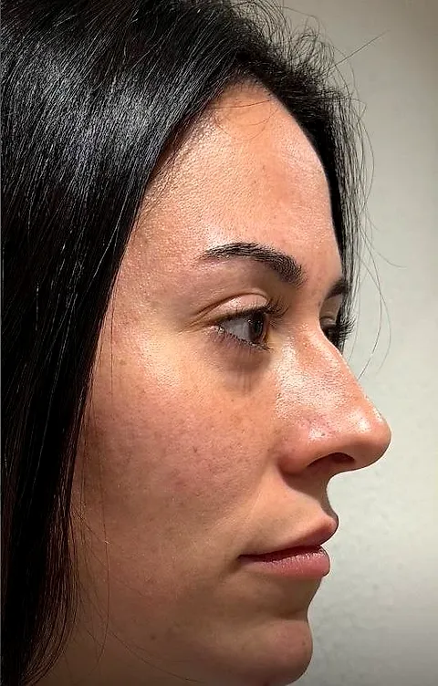 Liquid rhinoplasty, before